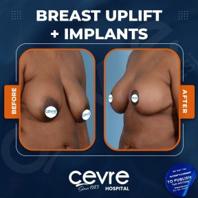 Vorher-nachher-Ergebnisse Brustimplantate mit Straffung bei Adem and Havva Medical Center