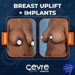 Vorher-nachher-Ergebnisse Brustimplantate mit Straffung bei Adem and Havva Medical Center