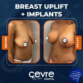 Vorher-nachher-Ergebnis Brustimplantate mit Straffung bei Adem and Havva Medical Center