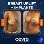 Vorher-nachher-Ergebnis Brustimplantate mit Straffung bei Adem and Havva Medical Center