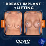 Vorher-nachher-Ergebnis Brustimplantate mit Straffung bei Adem and Havva Medical Center