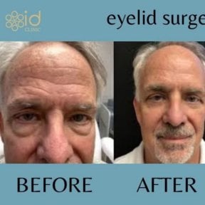 Before and after droopy eyelid surgery results at ID Clinic Bangkok, improved eye appearance
