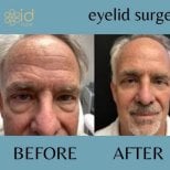 Before and after droopy eyelid surgery results at ID Clinic Bangkok, improved eye appearance