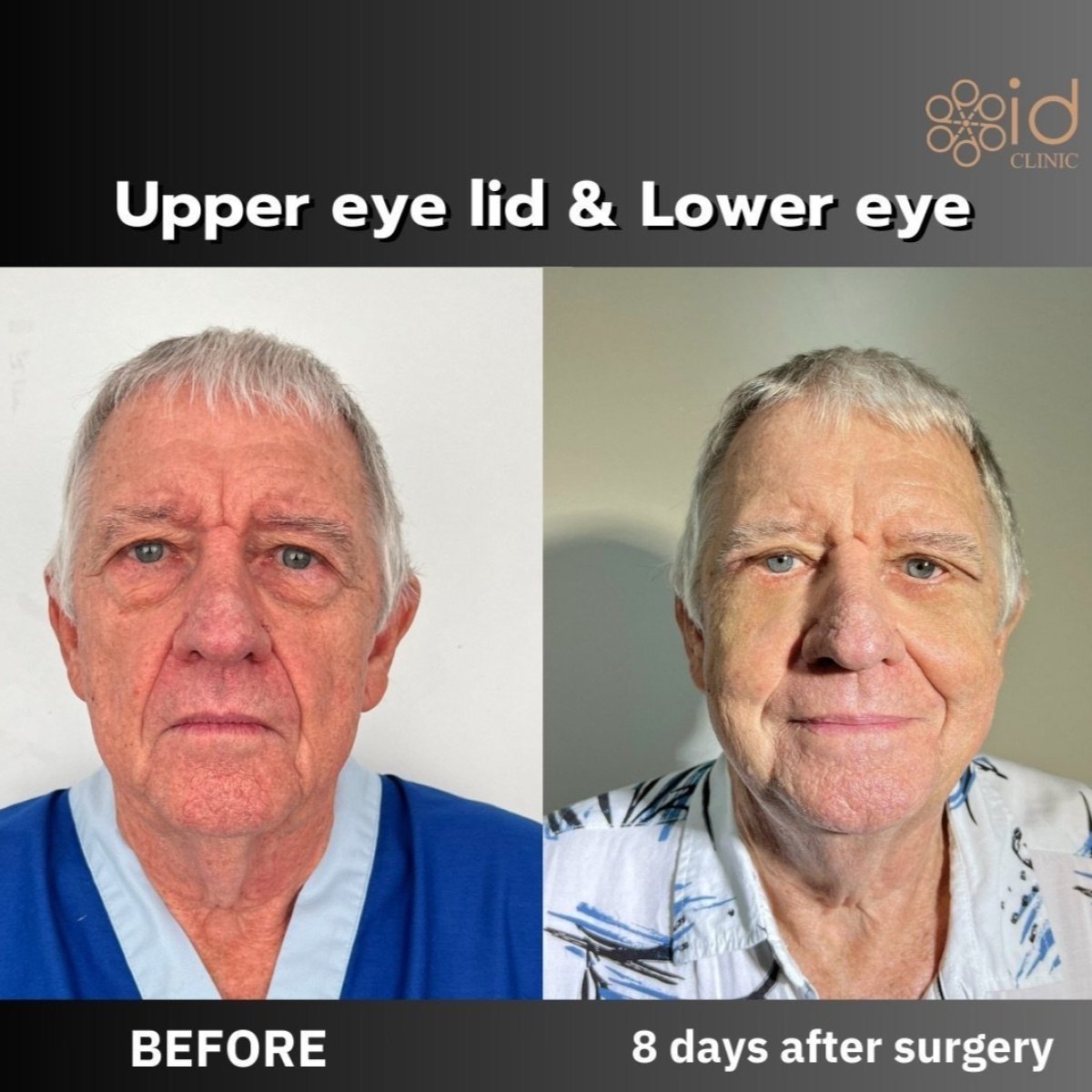 Resultados antes y después de cirugía de párpados caídos en ID Clinic Bangkok, blefaroplastia