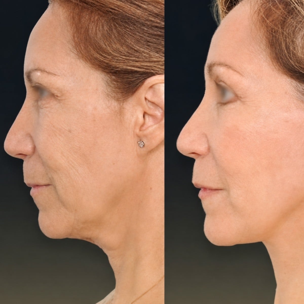 Resultados de lifting facial antes y después en Memorial Şişli Hospital – rejuvenecimiento