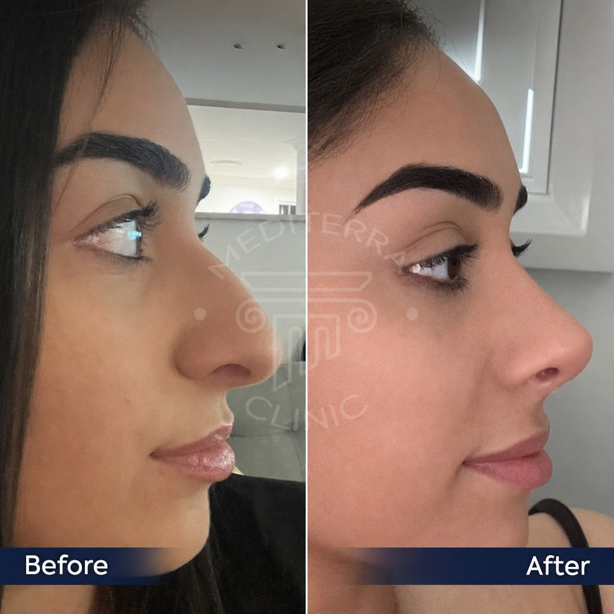نتائج قبل وبعد عملية تجميل الأنف المفتوحة في عيادة د. صفا مناف، إعادة تشكيل الأنف