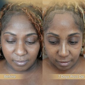 Vorher-nachher-Ergebnis der offenen Rhinoplastik in der Dr. Safa Manav Klinik, 7 Tage post-op