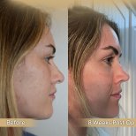 Vorher-nachher-Ergebnis der offenen Rhinoplastik in der Dr. Safa Manav Clinic, Nasenkorrektur
