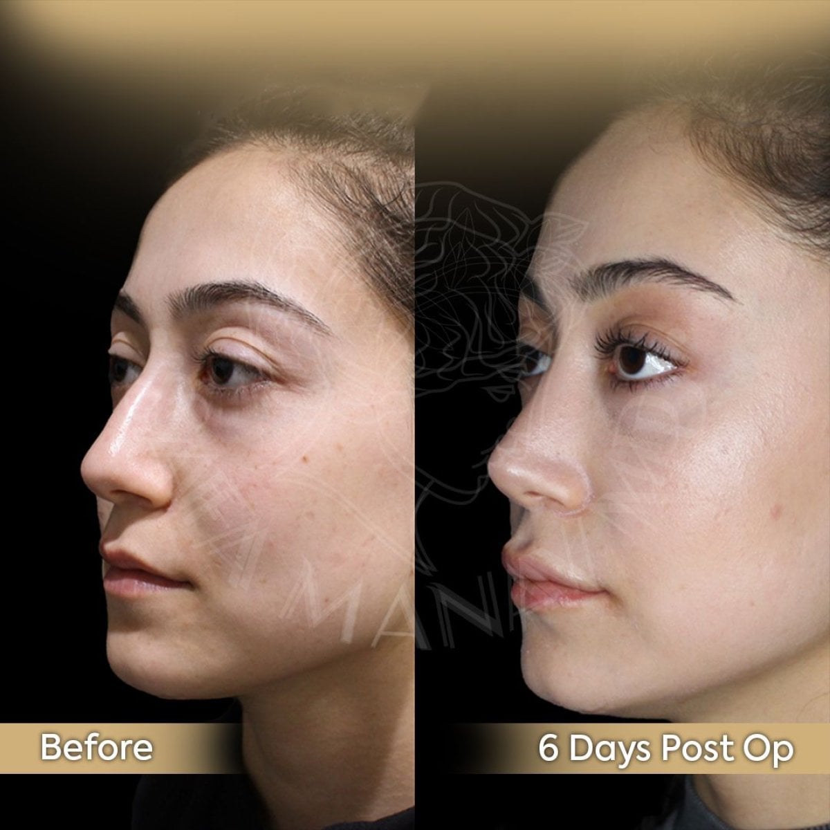 نتائج قبل وبعد عملية تجميل الأنف المفتوحة في عيادة Dr. Safa Manav، تغيير شكل الأنف واضح
