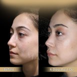 Vorher-nachher-Ergebnis der offenen Rhinoplastik bei Dr. Safa Manav Clinic, sichtbare Nasenkorrektur