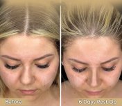 Vorher-nachher-Ergebnis der offenen Rhinoplastik in der Dr. Safa Manav Klinik, 6 Tage postoperativ