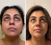 Vorher-nachher-Ergebnisse der offenen Rhinoplastik in der Dr. Safa Manav Klinik, verbesserte Nasenform