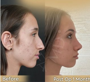 Vorher-nachher-Ergebnisse der offenen Rhinoplastik in der Dr. Safa Manav Klinik, verbesserte Nasenform