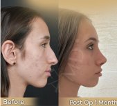 Vorher-nachher-Ergebnisse der offenen Rhinoplastik in der Dr. Safa Manav Klinik, verbesserte Nasenform
