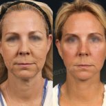 Facelift before and after results at Memorial Antalya Hospital, visible facial rejuvenation