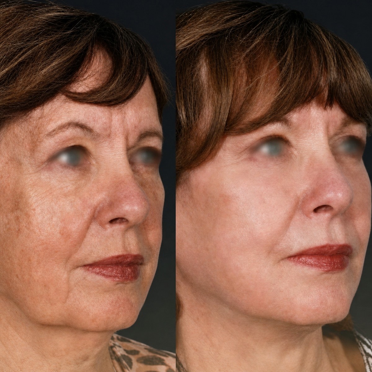 Resultados de lifting facial antes y después en Memorial Antalya Hospital, rejuvenecimiento facial