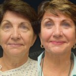 Before and after facelift results at Memorial Antalya Hospital, visible facial rejuvenation