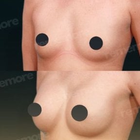 Результати до і після збільшення грудей у Memorial Antalya Hospital, покращена форма грудей