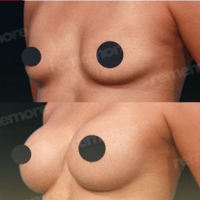 Before and after breast augmentation results at Memorial Antalya Hospital, enhanced breast shape