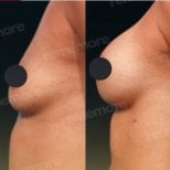 Before and after breast augmentation results at Memorial Antalya Hospital, enhanced breast shape