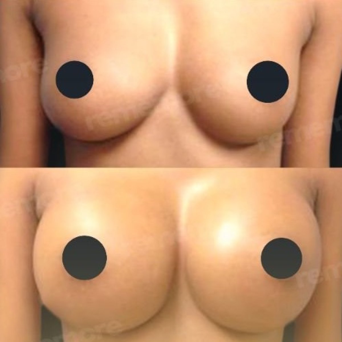 Vorher-nachher-Ergebnisse Brustvergrößerung bei Memorial Antalya Hospital, vollere Brustform