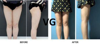 Vorher-nachher-Ergebnis Oberschenkelstraffung bei VG Plastic Surgery, verbesserte Beinkontur