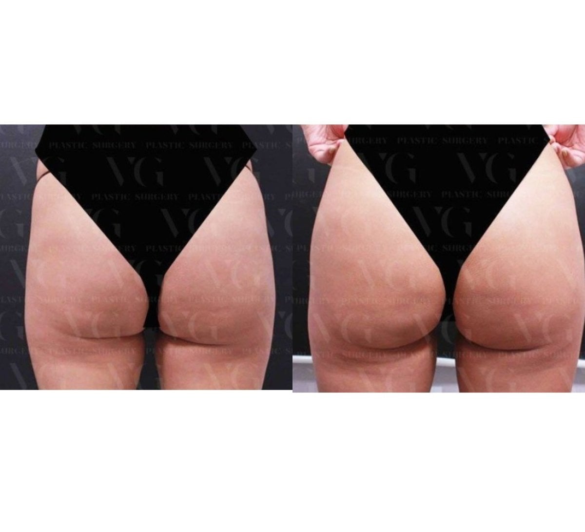 Resultados de lifting de muslos antes y después en VG Plastic Surgery, mejor contorno
