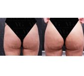 Vorher-nachher-Ergebnis Oberschenkelstraffung bei VG Plastic Surgery, verbesserte Kontur