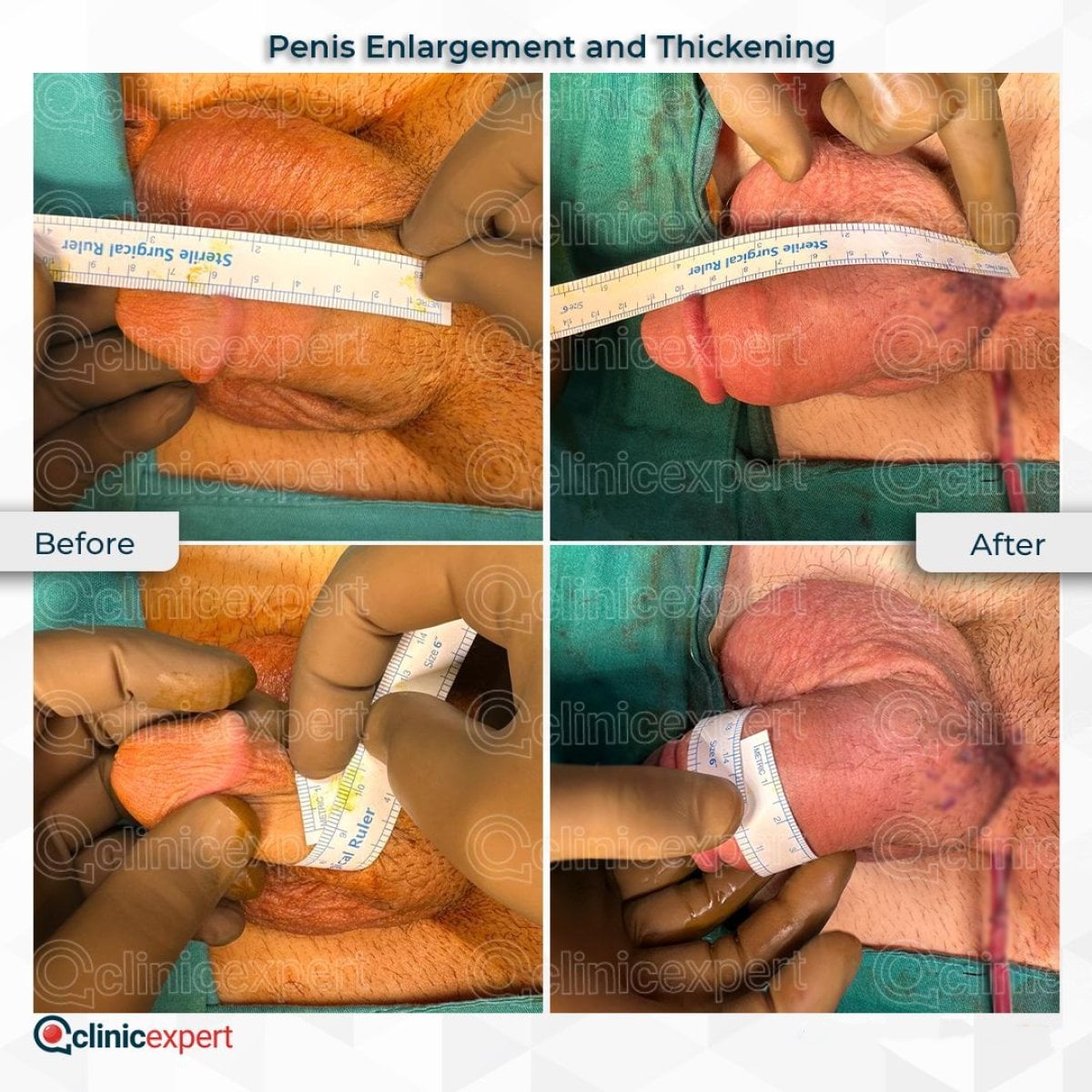Resultados de agrandamiento de pene Peniflex antes y después en CE International Hospital, mayor grosor