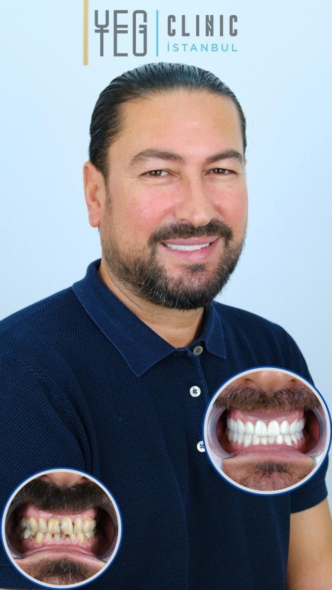 Resultados de bonding dental antes y después en YEG Clinic – sonrisa mejorada y dientes blancos