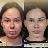 Facelift Vorher-Nachher-Ergebnisse in der Dr. Safa Manav Klinik, sichtbare Verjüngung