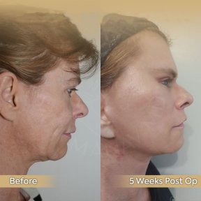 Facelift Vorher-Nachher-Ergebnis bei Dr. Safa Manav Clinic, sichtbare Kiefer- und Halsstraffung