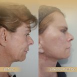 Facelift Vorher-Nachher-Ergebnis bei Dr. Safa Manav Clinic, sichtbare Kiefer- und Halsstraffung