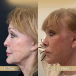 Facelift Vorher-Nachher-Ergebnisse in der Dr. Safa Manav Klinik, sichtbare Verjüngung