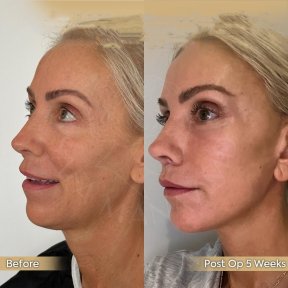 Facelift Vorher-Nachher-Ergebnis bei Dr. Safa Manav Clinic, sichtbare Verjüngung nach 5 Wochen
