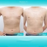 Gynecomastia surgery before and after results at Wansiri Hospital, flatter chest in 14 days