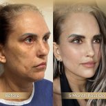 Facelift Vorher-Nachher-Ergebnisse in der Dr. Safa Manav Klinik, 5 Monate postoperativ
