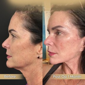 Facelift Vorher-Nachher-Ergebnisse in der Dr. Safa Manav Klinik, sichtbare Verjüngung