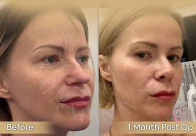 Vorher-nachher-Rhinoplastik bei Dr. Safa Manav Clinic, verbesserte Nasenform nach 1 Monat