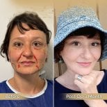 Facial fat transfer before and after results at Dr. Safa Manav Clinic, 3 months post-op