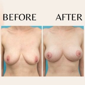 Before and after breast lift results at ID Clinic Bangkok, improved breast shape and contour