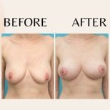 Before and after breast lift results at ID Clinic Bangkok, improved breast shape and contour
