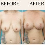 Before and after breast lift results at ID Clinic Bangkok, improved breast shape and contour