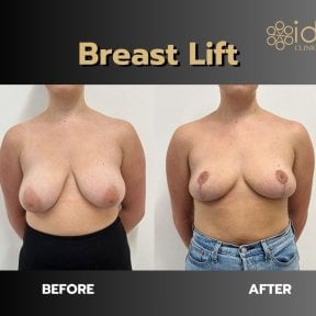 Before and after breast lift results at ID Clinic Bangkok, improved breast shape and lift