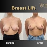 Before and after breast lift results at ID Clinic Bangkok, improved breast shape and lift