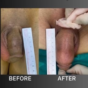Before and after surgical penile lengthening results at ID Clinic Bangkok with visible increase