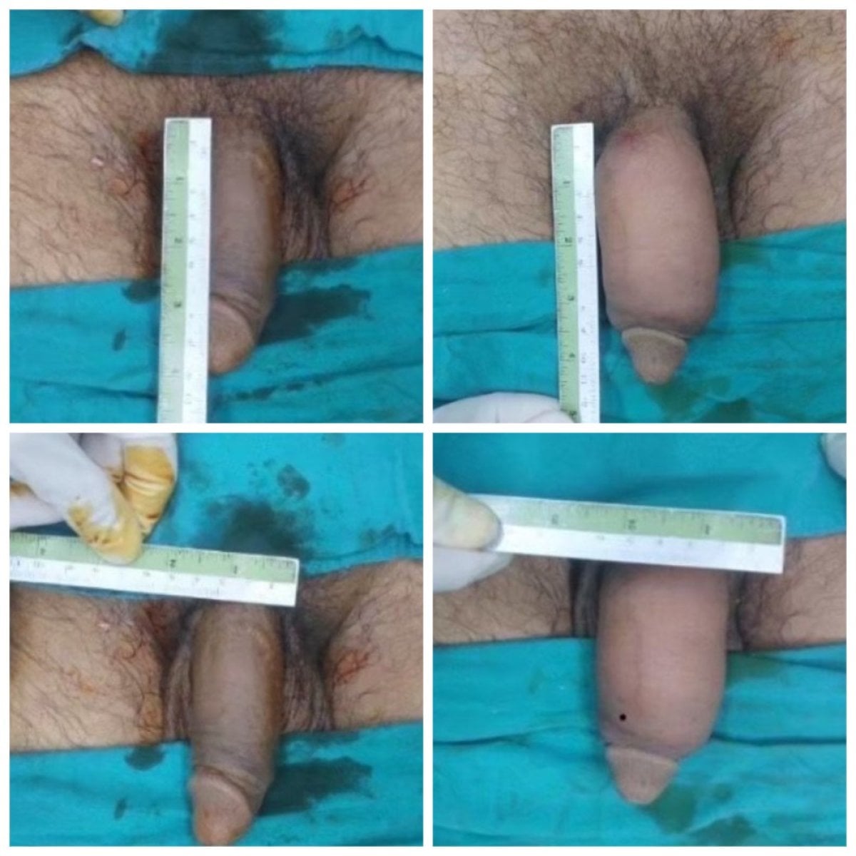 نتائج قبل وبعد تطويل القضيب الجراحي في ID Clinic Bangkok مع زيادة واضحة في الحجم