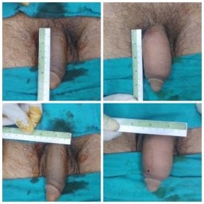 Before and after surgical penile lengthening results at ID Clinic Bangkok with visible size increase
