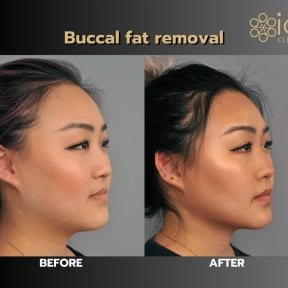 Before and after buccal fat extraction results at ID Clinic Bangkok, slimmer facial contour
