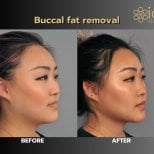 Before and after buccal fat extraction results at ID Clinic Bangkok, slimmer facial contour